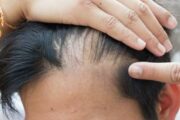 Врач-трихолог рассказала, как остановить выпадение волос после COVID-19
